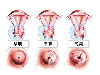 宫颈肥大有哪些常见症状(图2)