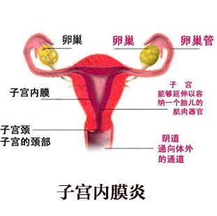 女性为什么会患上子宫内膜炎(图2)